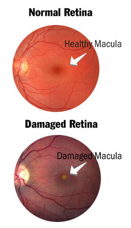 Solar Eclipse - Solar Retinopathy